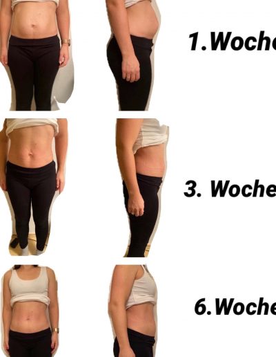 Rektusdiastase - VorherNachher 1