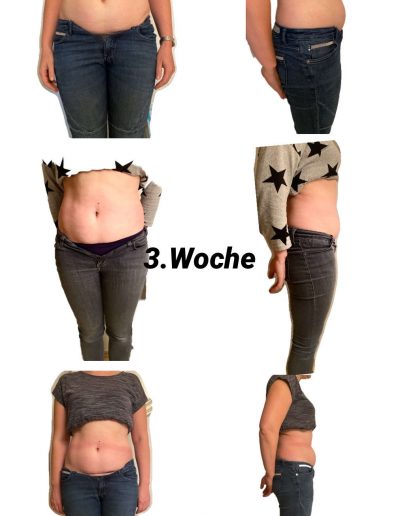 Rektusdiastase - VorherNachher 2