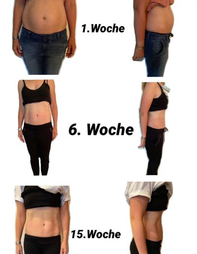 Rektusdiastase - VorherNachher 3