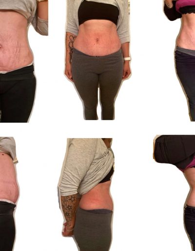 Rektusdiastase - VorherNachher 4