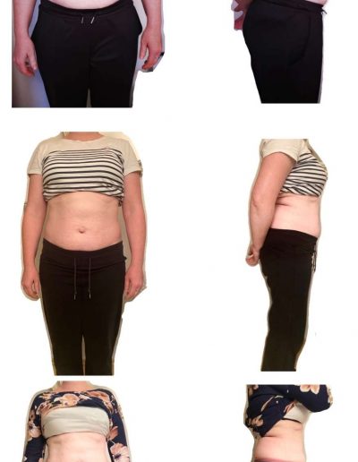 Rektusdiastase - VorherNachher 5