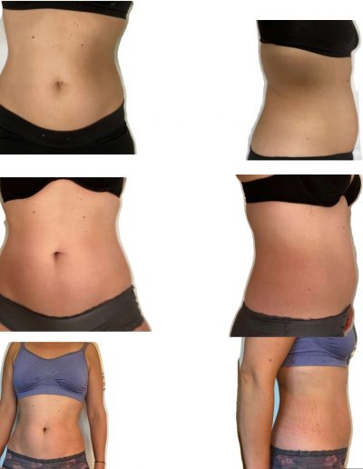 Rektusdiastase - VorherNachher 6